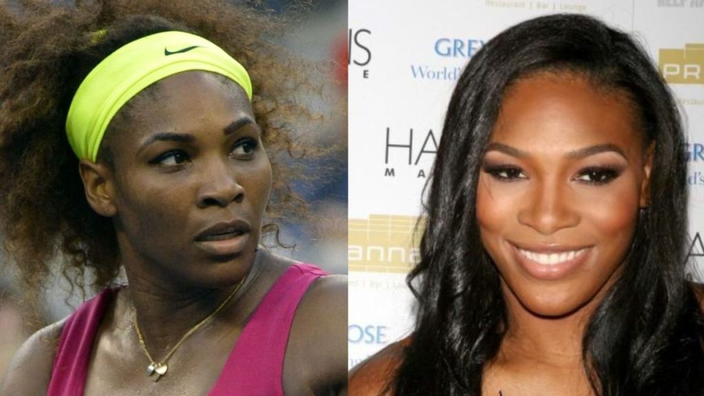 Serena Williams Plastic Surgery