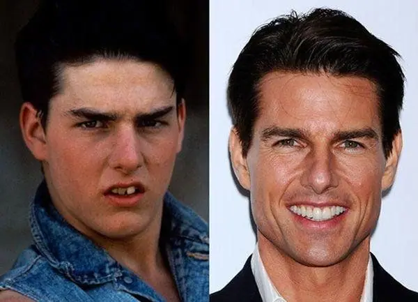 Tom Cruise Teeth: What Happened To His Middle Tooth and Does It Affect His Smile